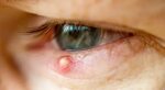40+ Best Vorrat Entzündung Augenlid Innen : Luft aus der Trä